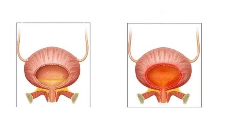 Normalne i pacjenci z zapaleniem pęcherzyków moczowych dróg moczowych
