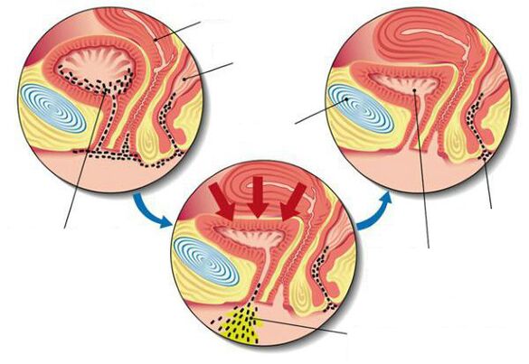 bakterie w pęcherzu z zapaleniem pęcherza moczowego