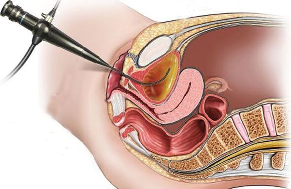 cystoskopia w przypadku zapalenia pęcherza moczowego